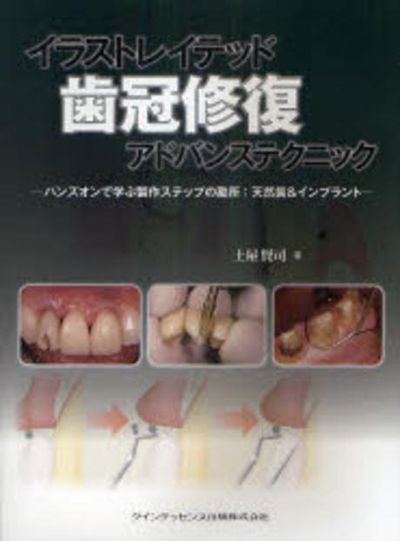 イラストレイテッド齒冠修復アドバンステクニック ハンズオンで學ぶ
