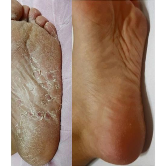 페로린 뒤꿈치갈라짐 각질제거 풋필링팩 로즈향 2회분